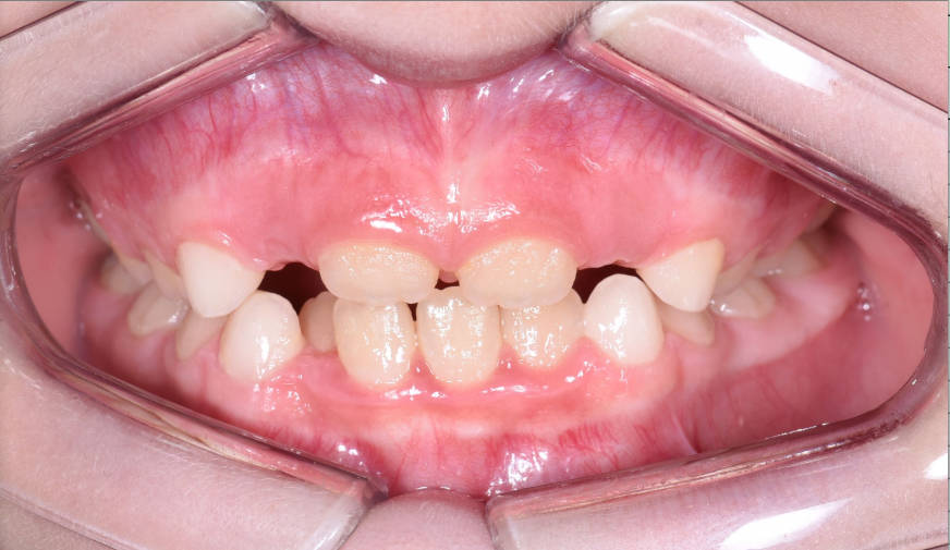 Работа врача: Исправление скученности зубов на нижней челюсти